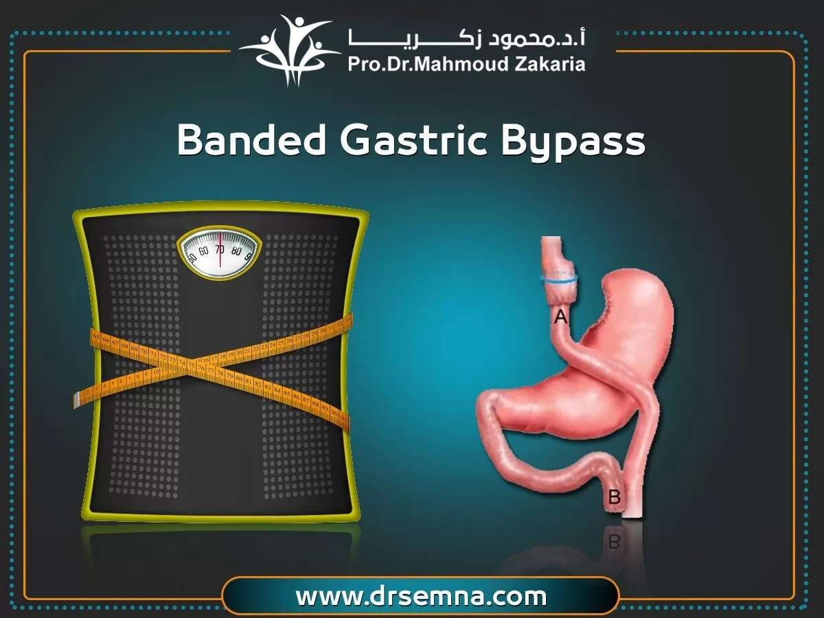 Banded Gastric Bypass