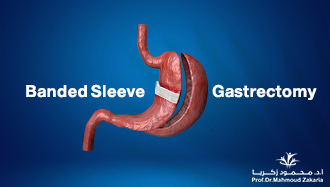 Banded Sleeve Gastrectomy