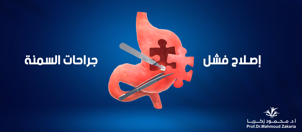 إصلاح فشل جراحات السمنة — إعادة عملية التكميم وتحويل المسار