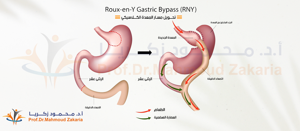 عملية تحويل مسار المعدة الكلاسيكى