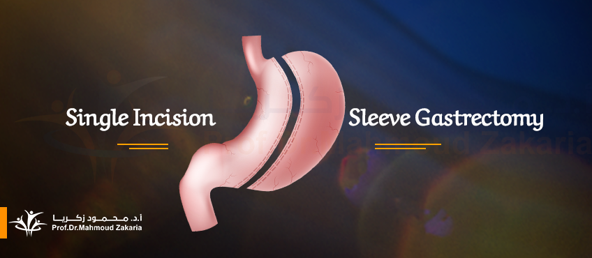 Single Incision Sleeve Gastrectomy