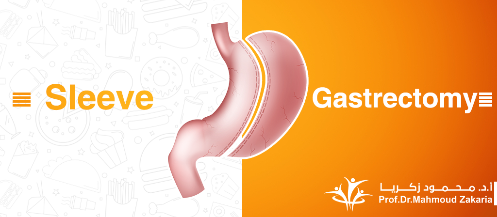 Sleeve gastrectomy