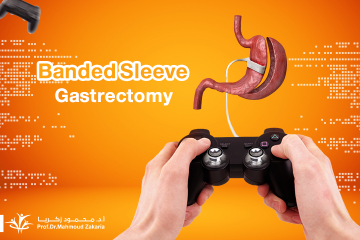 modified-sleeve-gastrectomy