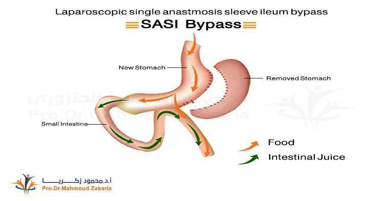 sasi-surgery