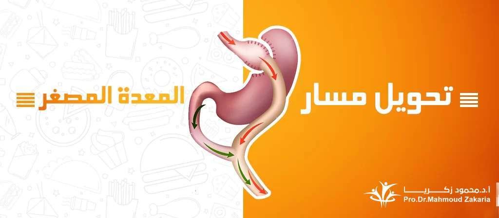 عملية-تحويل-مسار-المعدة-المصغر