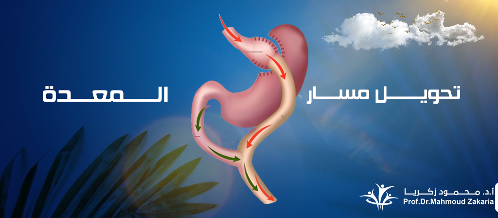 عملية-تحويل-مسار-المعدة-بالمنظار