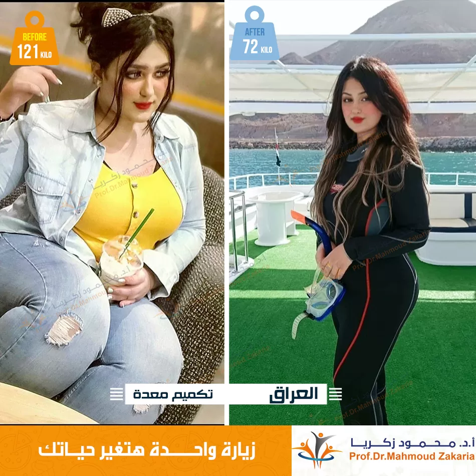 قصه-نجاح-عمليات-تكميم-معدة