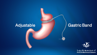 Laparoscopic Adjustable Gastric Band (LAGB)