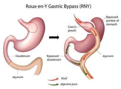 roux-en-ygastric-bypass