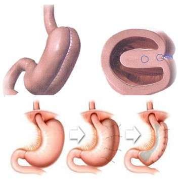 كرمشة-المعدة-بالمنظار