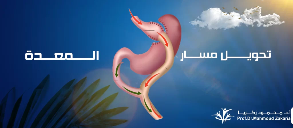 عملية-تحويل-مسار-المعدة-بالمنظار
