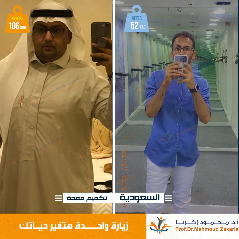 تكميم-بالمنظار