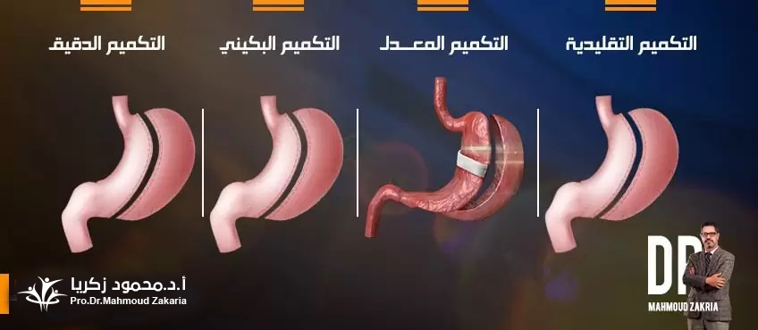 أنواع-عمليات-تكميم-المعدة