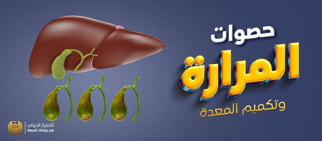 حصوات-المرارة-وتكميم-المعدة
