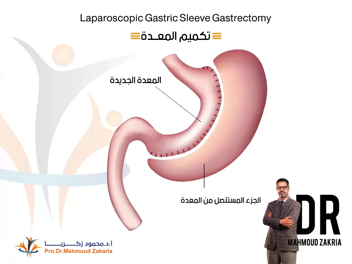 تكميم-المعدة