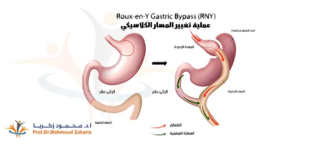 عملية تحويل المسار: تخلّصك من السمنة وعشرات الأمراض الأخرى